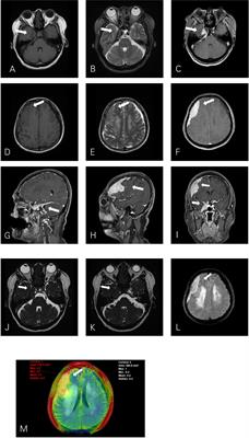 Case report: Primary intracranial mucosa-associated lymphoid tissue lymphoma presenting as two primary tumors involving the cavernous sinus and extra-axial dura, respectively